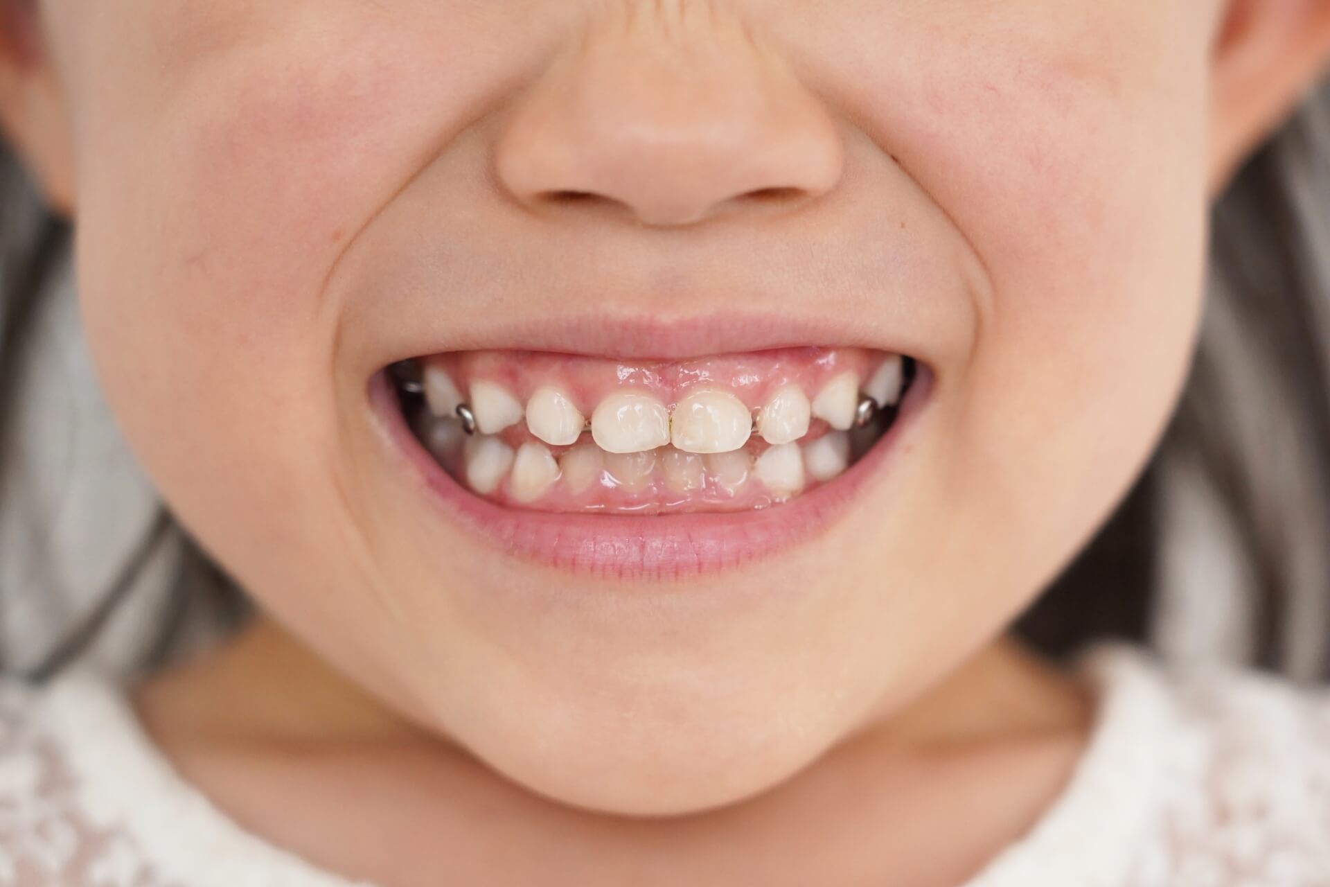 大人の矯正と異なる子どもの矯正歯科治療の進め方