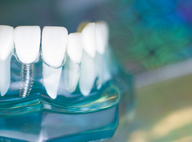 インプラントや外科処置を正確にしてほしい｜池袋の歯医者・歯科「Lily Smile Dental Clinic」