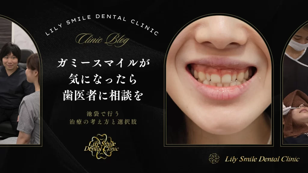 ガミースマイルが気になったら歯医者に相談を｜池袋で行う治療の考え方と選択肢