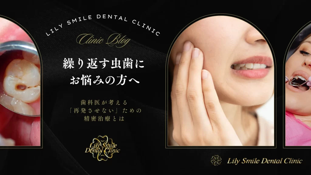 2026年2月20日_繰り返す虫歯にお悩みの方へ|歯科医が考える「再発させない」ための精密治療とは