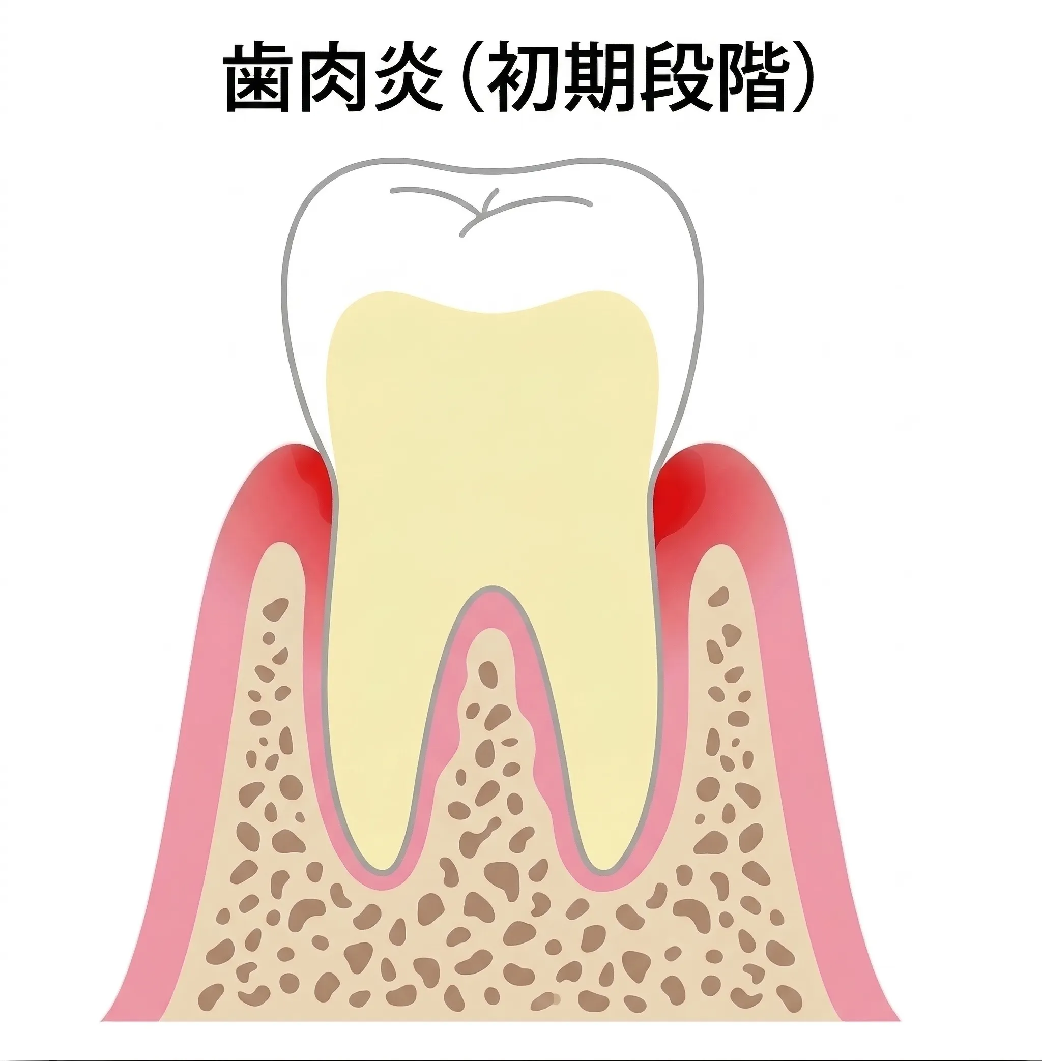 歯肉炎（初期段階）
