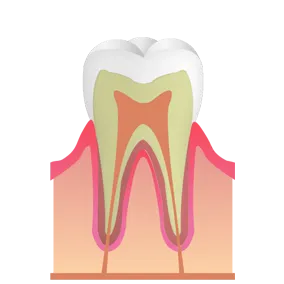 初期虫歯｜池袋の歯医者・歯科「Lily Smile Dental Clinic」