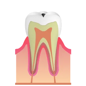 象牙質の虫歯｜池袋の歯医者・歯科「Lily Smile Dental Clinic」