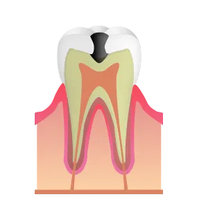 重度の虫歯｜池袋の歯医者・歯科「Lily Smile Dental Clinic」