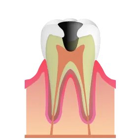 初期虫歯｜池袋の歯医者・歯科「Lily Smile Dental Clinic」