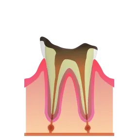 初期虫歯｜池袋の歯医者・歯科「Lily Smile Dental Clinic」