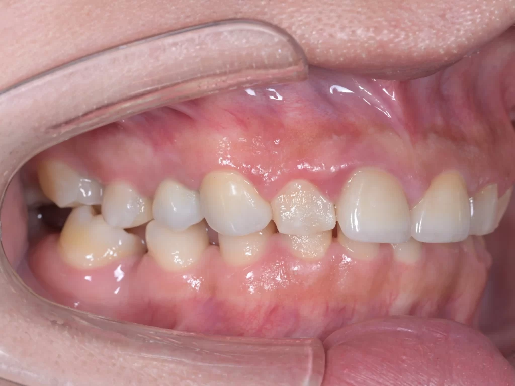 after①｜池袋の歯医者・歯科「Lily Smile Dental Clinic」